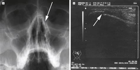Identification of Nasal Bone Fractures on Conventional .